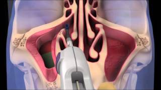 Acclarent Spin Balloon Sinuplasty Animation Acclarent Aera Eustachian Tube Balloon Dilation System Animation