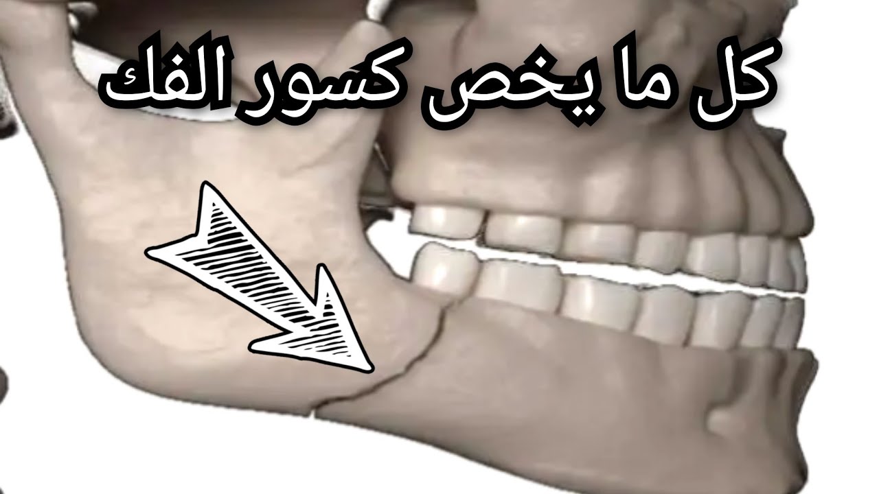 كسور الفك  #كسور_الفك د إيريني ابادير