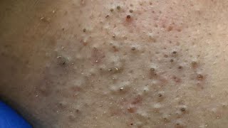 Deep Dive into Pimple Popping — Effective Remedies For Acne Treatment