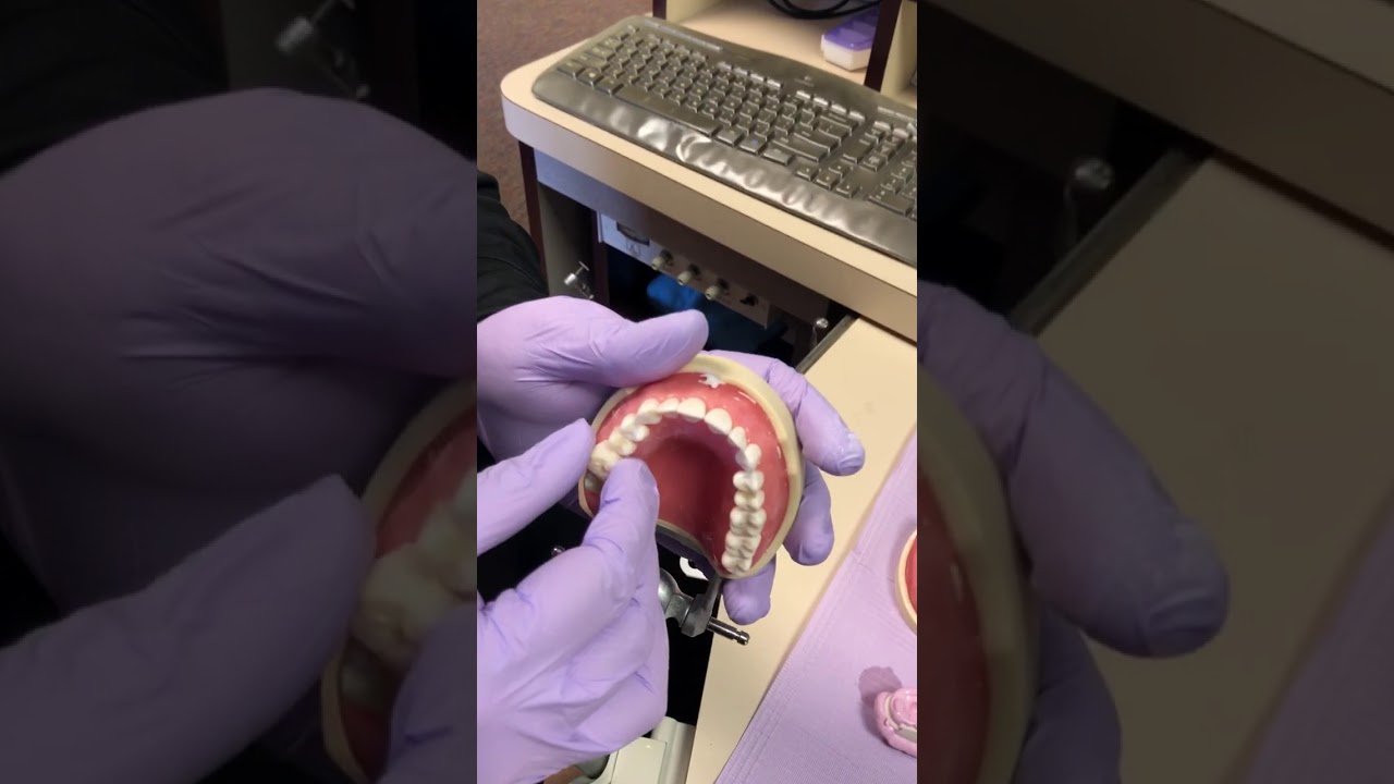 How to Make a Temporary Crown Part 3