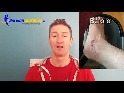 A case of Scar Sensitivity