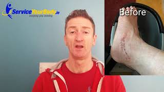 A case of Scar Sensitivity