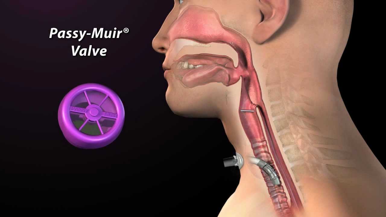 passy muir valve placement youtube t tube placement