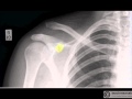 Interpreting X-Rays of the Shoulder Joint