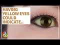 Health Talk Causes And Conditions Of Yellow Eyes 