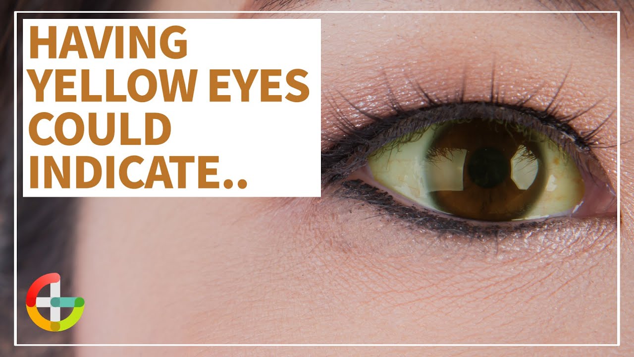 Health Talk] Causes and Conditions of Yellow Eyes 
