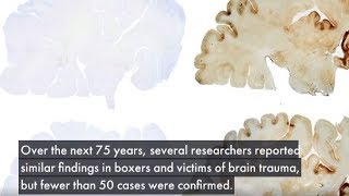 A Brief History of Chronic Traumatic Encephalopathy (CTE)