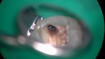 18082 4 4 mm broken file removal with a precurved TFRK S ultrasonic tip