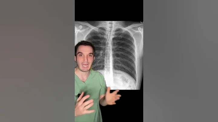 Radiologist versus AI: diagnosing brain bleed and Tin Man Syndrome myself versus ChatGPT and Grok