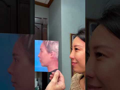 Video thumbnail: 6th Revision Rhinoplasty is a Charm - 3 year follow up! · Rod J. Rohrich, M.D. Plastic Surgeon