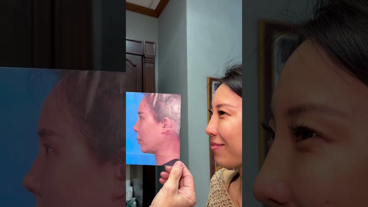 6th Revision Rhinoplasty is a Charm - 3 year follow up!