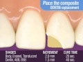 Henry schein uk  demonstration creating anterior restorations using a multishade technique