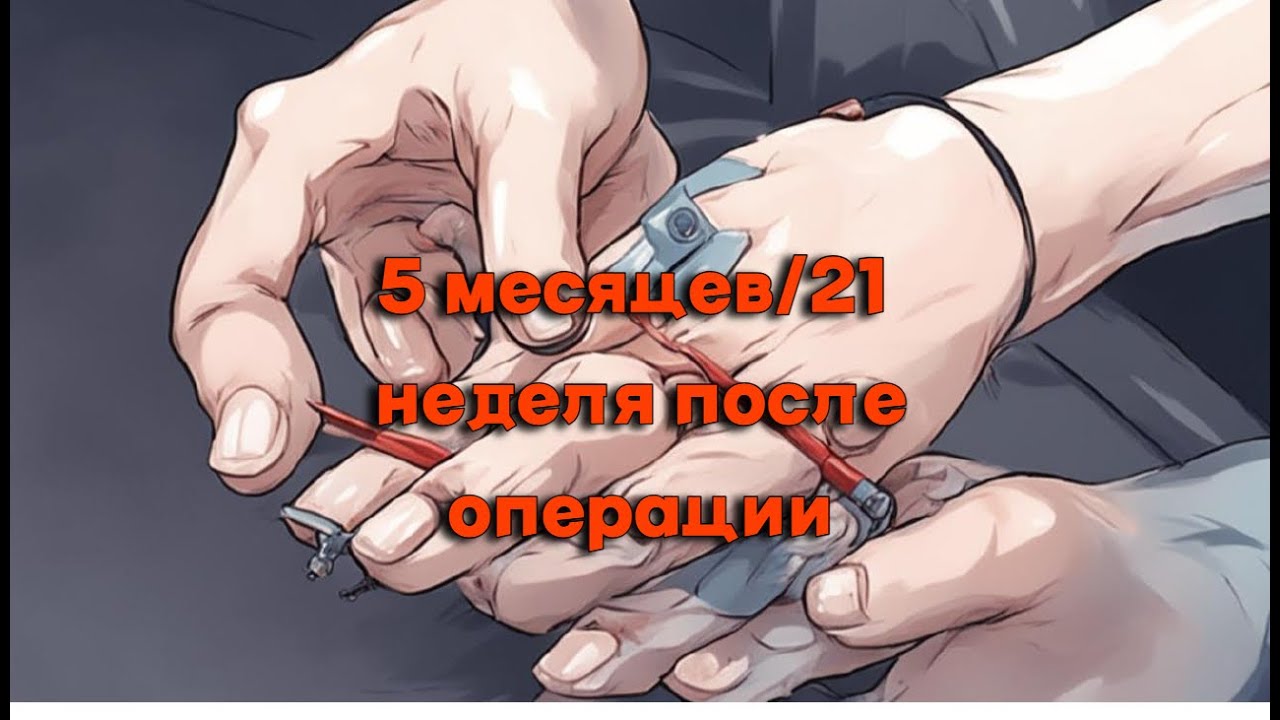 5 месяцев после операции TFCC и тыльный капсулодез полулунно-ладьевидной связки. Объем движений
