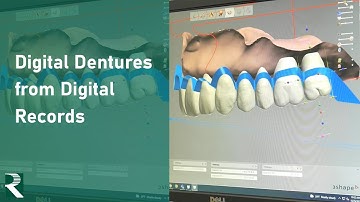 Digital Dentures from Digital Records: Digital Denture Workflow