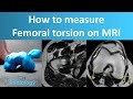 How to measure femoral torsion on MRI