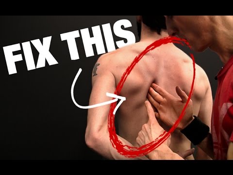 Youtube Kode Icd X Scoliosis