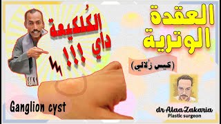 Ganglion Cyst || العقدة الوترية (الكيس الزلالي)