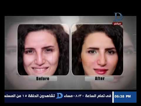 الأكلات المشهورة في ألمانيا سيداتي انساتي - حلم كل سيدة لجمال بشرتها مع د.هشام شعبان استشاري جراحة تجميل الوجه والانف