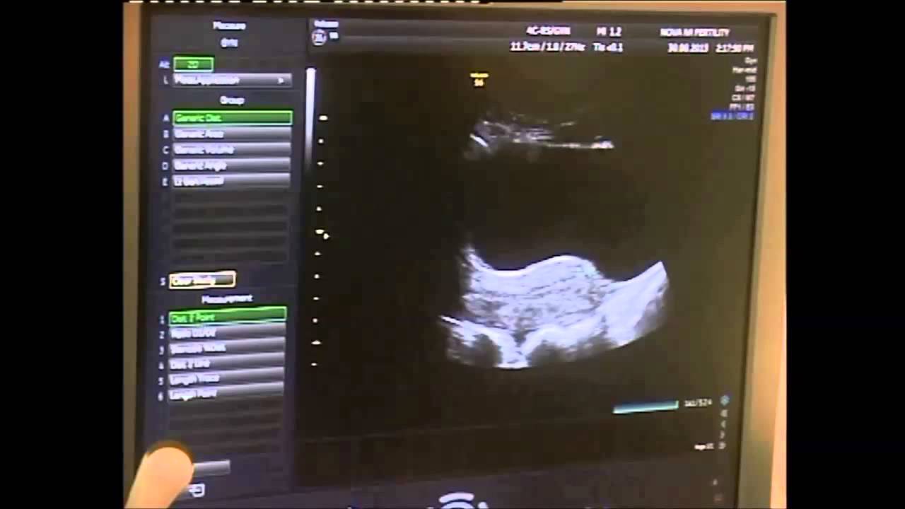 Dr Kaberi Banerjee Live Demonstration of Egg Collection and Embryo Transfer