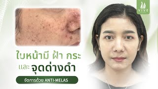 EP.17 l ฝ้า กระ จุดด่างดำ แก้ยากแค่ไหน ก็จบได้ด้วยโปรแกรม ANTI-MELAS l The Vive Clinic