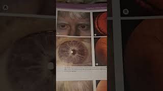 Tyrosinase-Negative Oculocutaneous Albinism (OCA1A): Complete Absence of Melanin Production