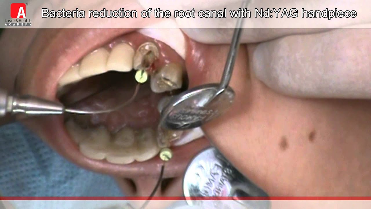 Disinfection of the root Canal with Fotona Lightwalker NdYAG Laser
