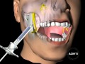 инфильтрационная анестезия верхней челюсти...infiltration anesthesia of the upper jaw