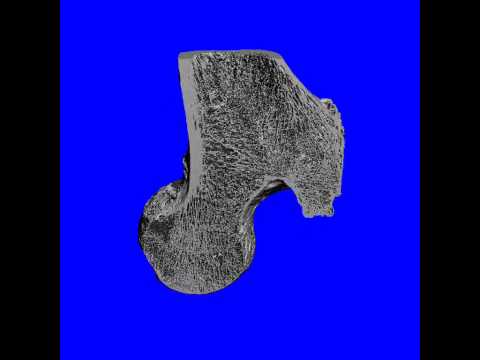 Bone Femur CT