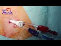 Long term Amecath Hemodialysis catheter insertion procedure