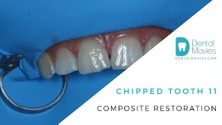 Chipped tooth 11 -  composite restoration