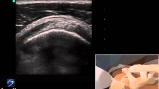 3D How To: Ultrasound Exam of the Supraspinatus Tendon - SonoSite Ultrasound screenshot 3
