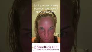 SmartXIDE DOT CO2 Laser Skin Resurfacing Night 1 Actual Patient Live Video Journal RealSelfie Vi...