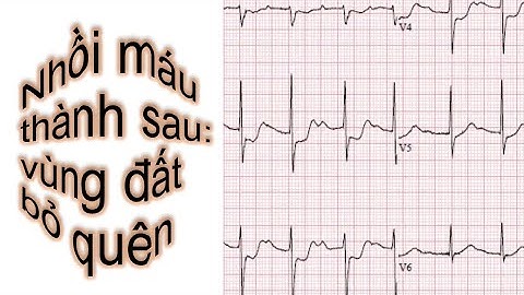 Đọc Điện tâm đồ(ECG): video 9: Nhồi máu cơ tim có ST chênh lên thành sau