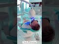Experience the Ultimate Teeth Whitening with Zoom Laser at EDEN AESTHETICS Clinic in Dubai