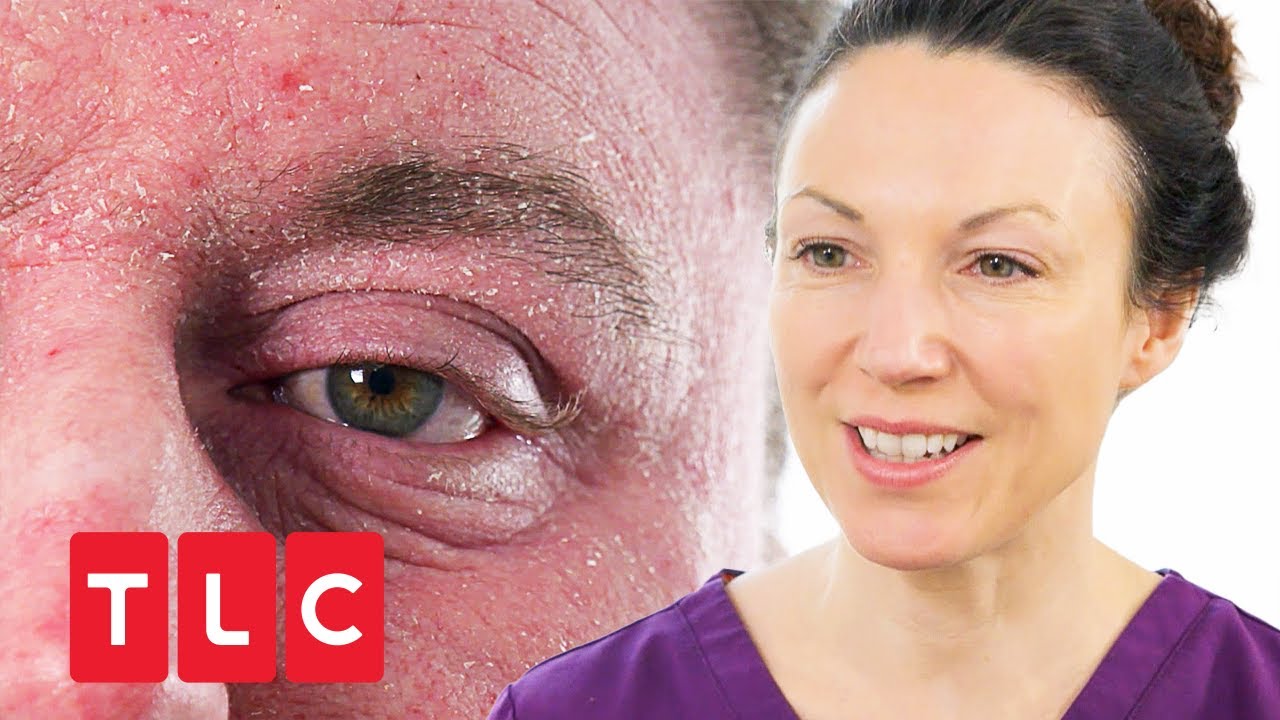 Extreme Neurodermitis | Dr. Emma: Hautärztin aus Leidenschaft | TLC Deutschland
