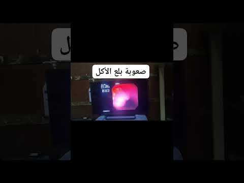 لازم تعمل منظار صعوبة بلع الأكل أسباب كتير منها فطريات المرئ 