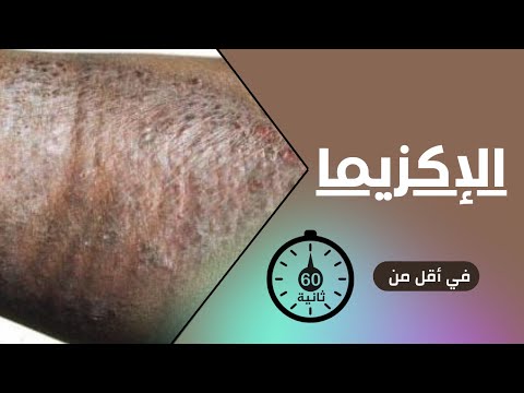 الإكزيما في أقل من 60 ثانية