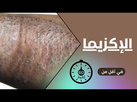 فيديو: كيفية تهدئة حكة الجفون: 11 خطوة (بالصور)