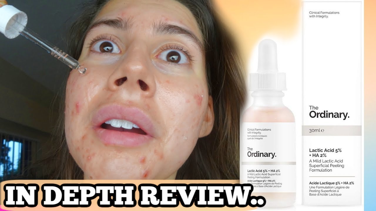I TESTED THE ORDINARY LACTIC ACID FOR MY ACNE SCARS FOR 3 WEEKS.. THIS