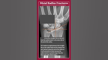 Out Now on the orthoPAc podcast! Distal Radius Fractures | Sam Dyer, PA-C, MHS