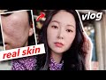 Revealing My Horrible Acne Scars! (visited top Korean skin care clinic)