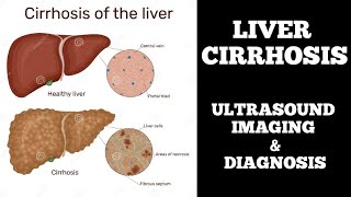 ULTRASOUND CASE STUDY OF LIVER CIRRHOSIS