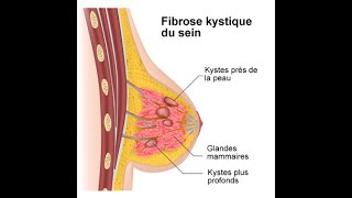 document complet sur le kyste mammaire,Adenofibrome,  calcification,Ecoulement(@nurseyolbeauty)