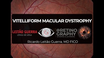 Vitelliform macular distrophy - Multimodal retinal imaging analysis