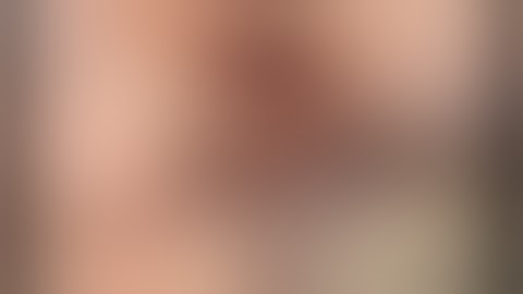 Hockey Stick Aortotomy and single layer closure CABG Cardiac Surgery