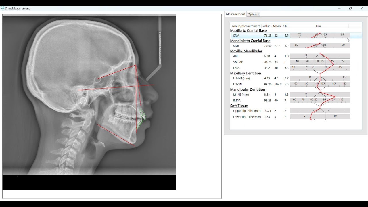 5-1 Cephalometric X ray Analysis