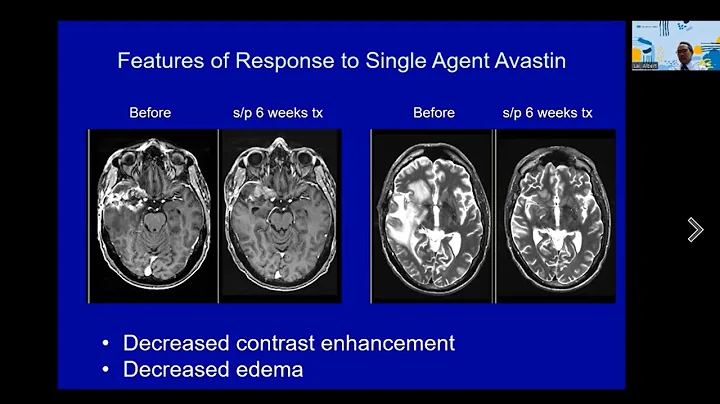 Chemotherapies and Biologic Agents in Treatment of Gliomas: UCLA Brain Tumor Virtual Conference 2022
