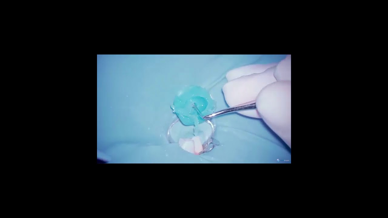 Sonendo GentleWave -- Removing the Platform