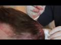 NeoGraft procedure at Paramount Plastic Surgery- Keith Jeffords, MD