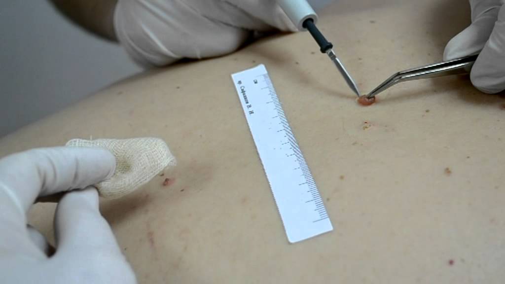 Невусы смешанные, удаление методом высокочастотной электрохирургии